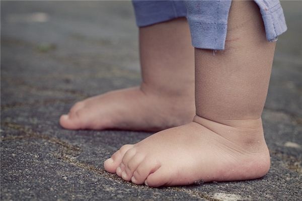 What does it mean to dream of swollen feet? What does it mean to dream of swollen feet?