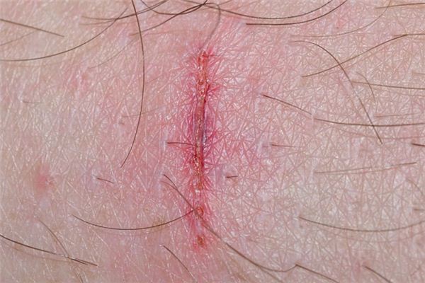 What does it mean to dream of licking a wound? What does it mean to dream of licking a wound?