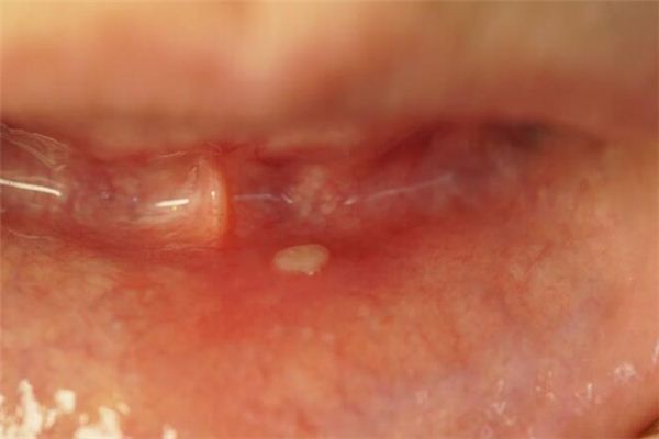 What does it mean to dream of festering sores? What does it mean to dream of festering sores?