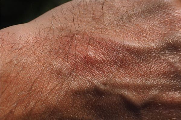 What does it mean to dream of pustules? What does it mean to dream of pustules?