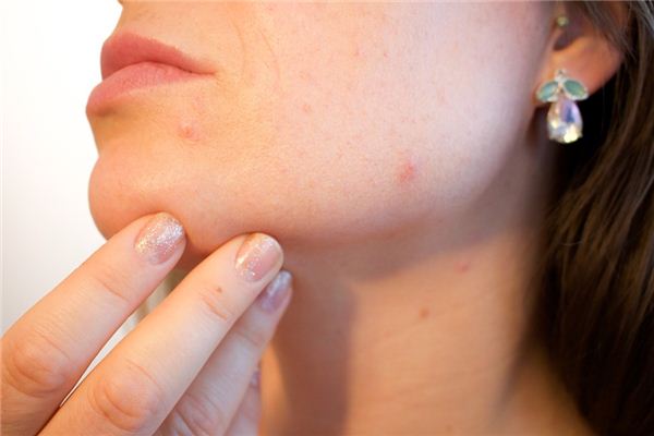 What does it mean to dream of blisters? What does it mean to dream of blisters?