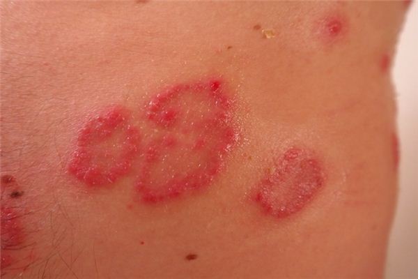 What does it mean to dream about a rash? What does it mean to dream about a rash?