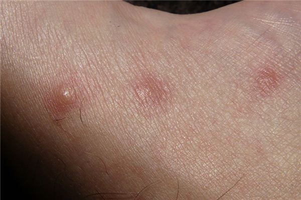 What does it mean to dream of itchy skin? What does it mean to dream of itchy skin?
