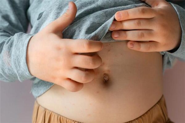 What does it mean to dream about scabies? What does it mean to dream about scabies?
