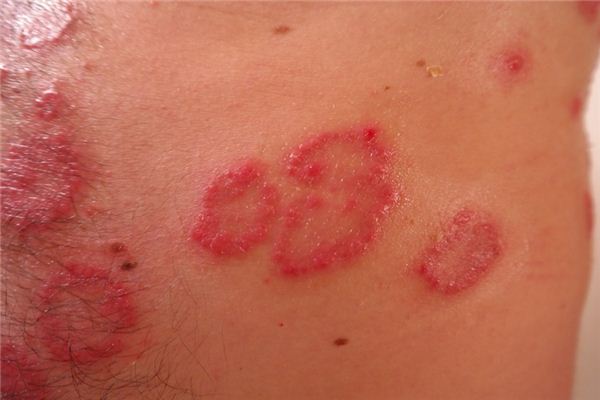 What does it mean to dream of sores and wounds? What does it mean to dream of sores and wounds?