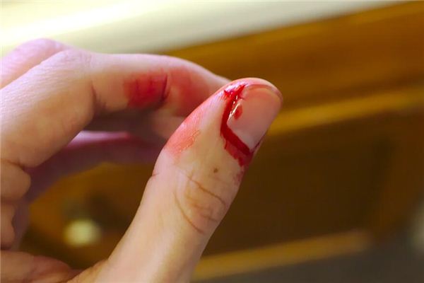 What does it mean to dream of bleeding hands? What does it mean to dream of bleeding hands?
