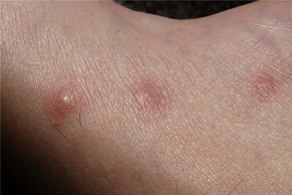 What does it mean to dream of rubella? What does it mean to dream of rubella?