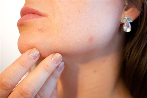 What does it mean to dream of papules? What does it mean to dream of papules?