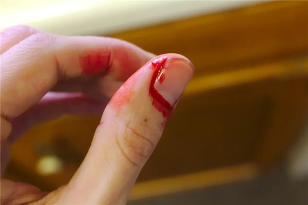 What does it mean to dream of having your hand cut off? What does it mean to dream of having your hand cut off?