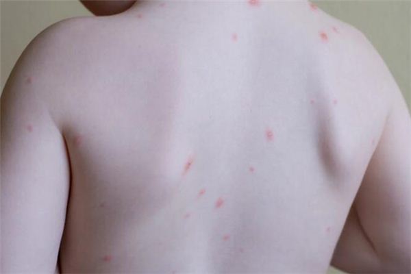 What does it mean to dream about hives? What does it mean to dream about hives?