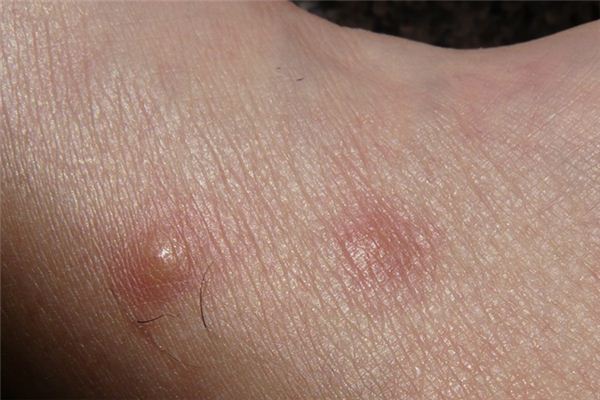 What does it mean to dream about allergies? What does it mean to dream about allergies?