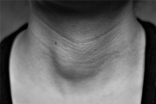 What does it mean to dream about a tumor? What does it mean to dream about a tumor?