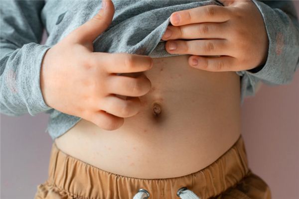 What does it mean to dream of having scabies? What does it mean to dream of having scabies?