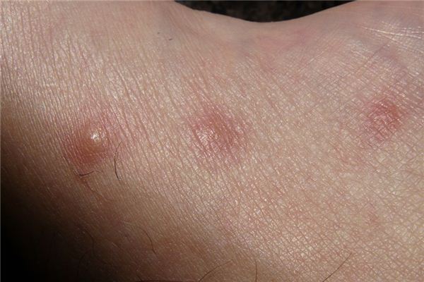 What does it mean to dream of having an itchy body? What does it mean to dream of having an itchy body?