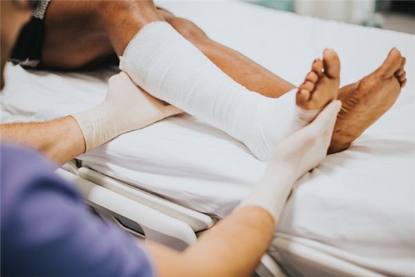 What does it mean to dream of a broken leg? What does it mean to dream of a broken leg?