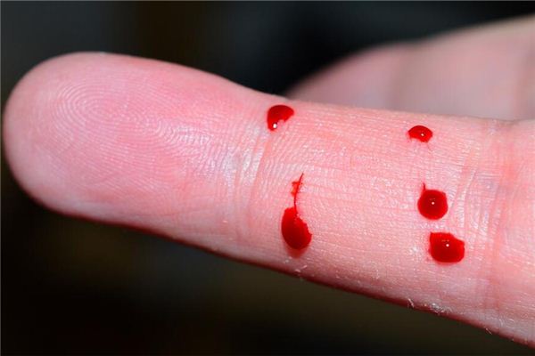 I dreamed of being pricked by a splinter.